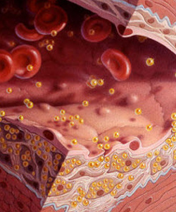 Атеросклероз и другие сердечно-сосудистые заболевания: роль пищевых волокон на базе пищевых добавок фирмы Vita Line в профилактике и лечении